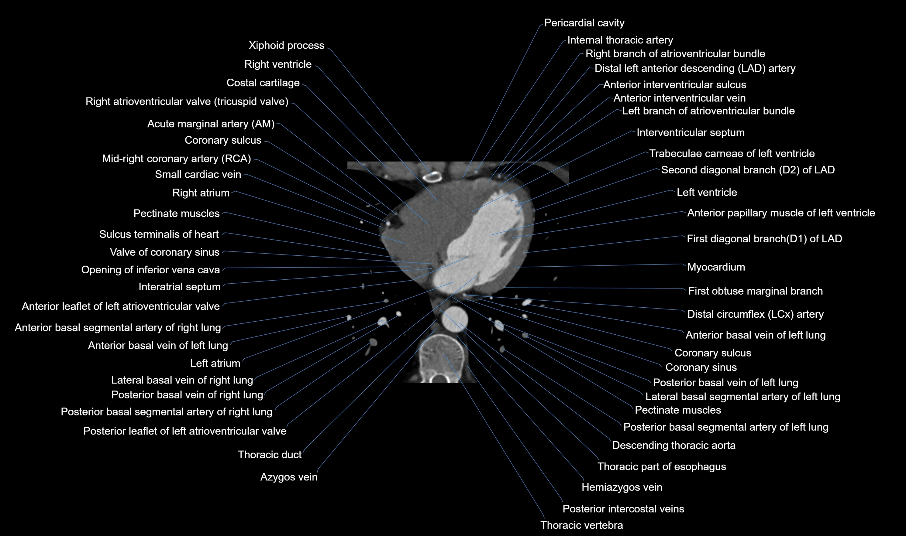 CT heart (coronary angiogram) axial view cross sectional anatomy labelled radiology image-00045.webp